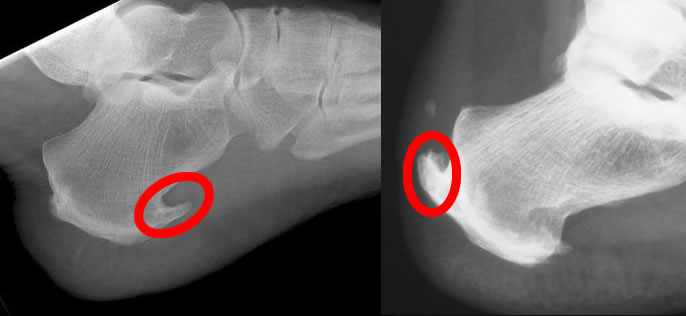 Radiografia de um esporão de calcâneo